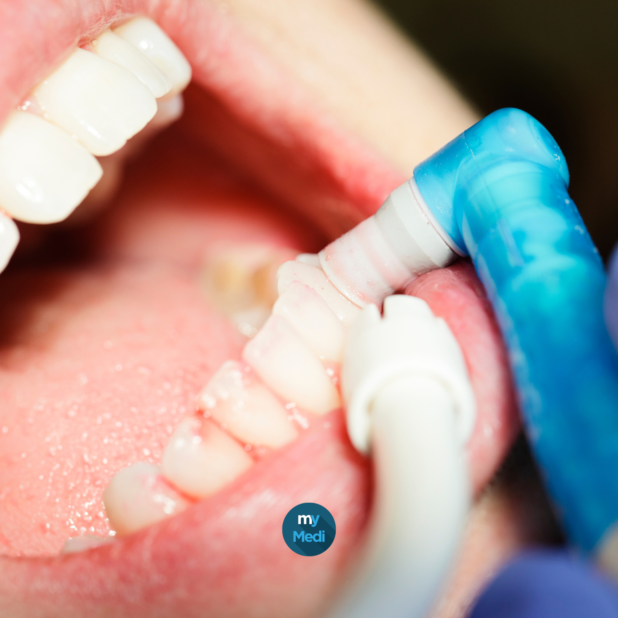 Finition et polissage dentaire