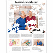Planche anatomique - La maladie d'Alzheimer - Anatomie et pathologie - 3B Scientific
