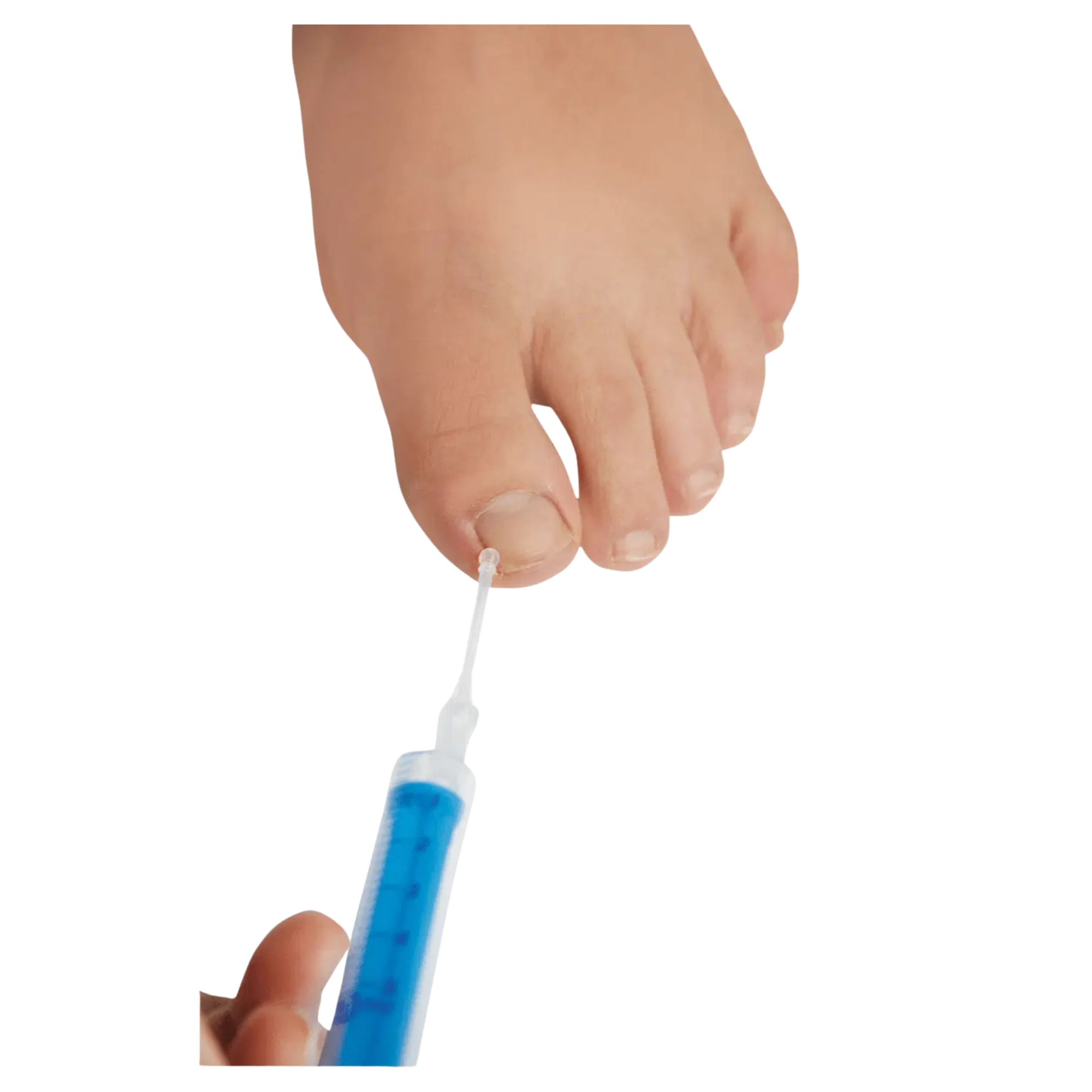 Sterile disposable button cannula - Ruck