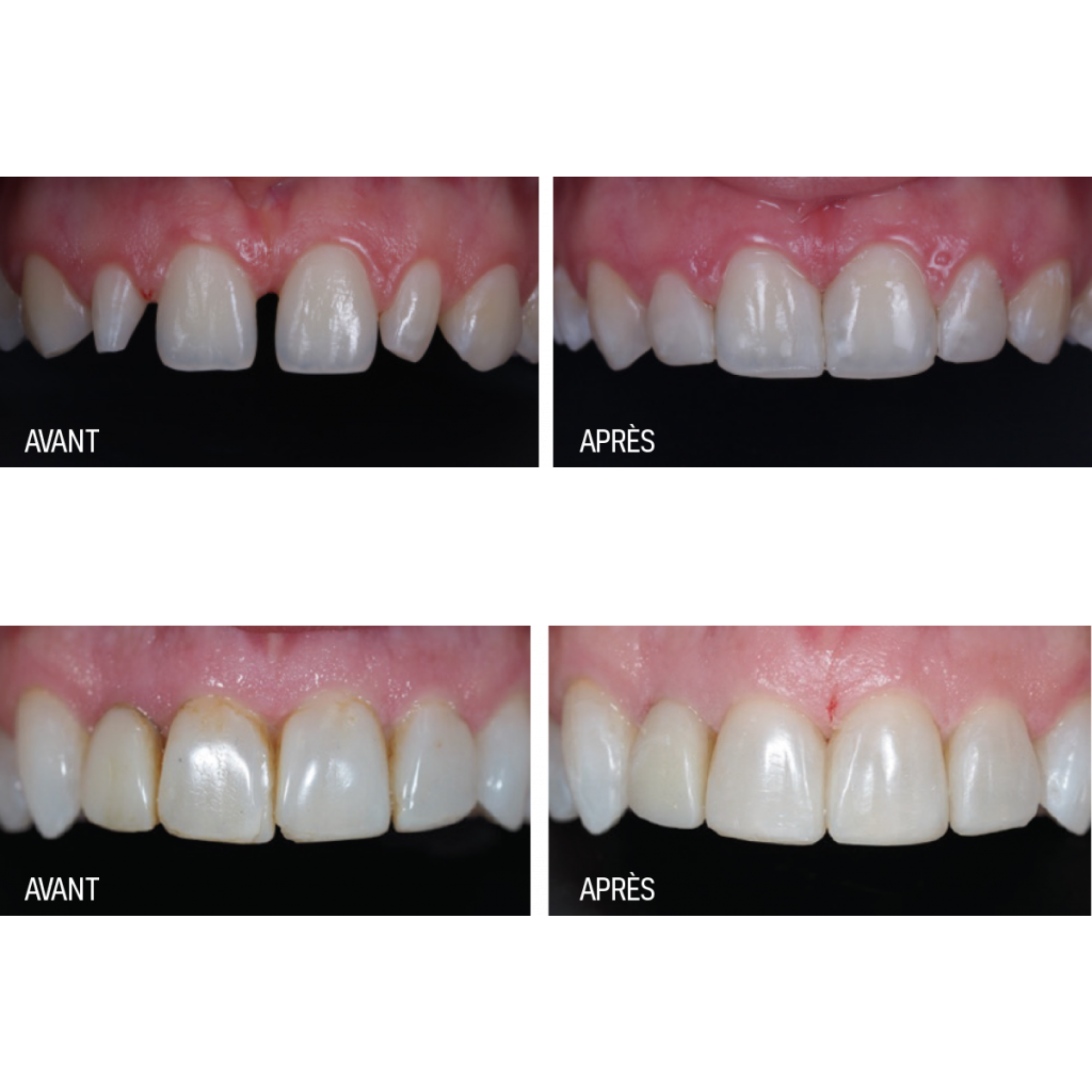 Luna 2 - composite universel - 4 g - plusieurs teintes - SDI