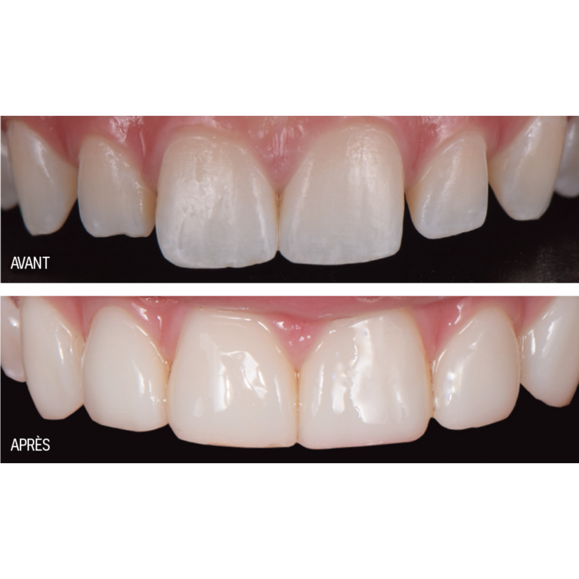 Luna 2 - composite universel - 4 g - plusieurs teintes - SDI