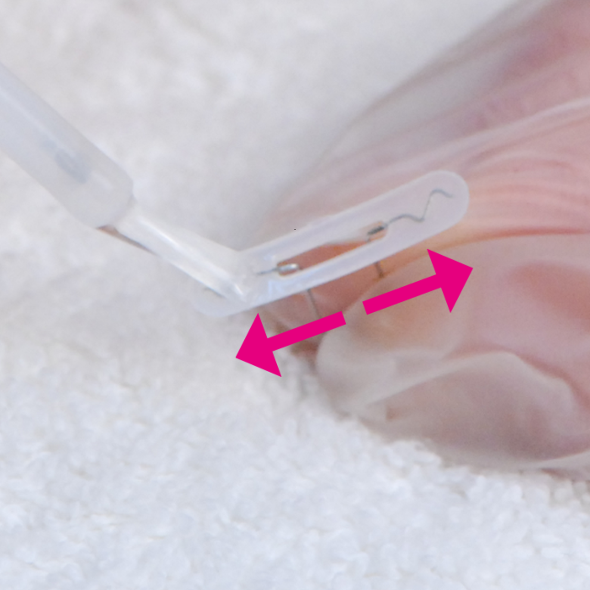 Kit complet d’orthonyxie pour ongles incarnés et déformés – Podofix - My Médical