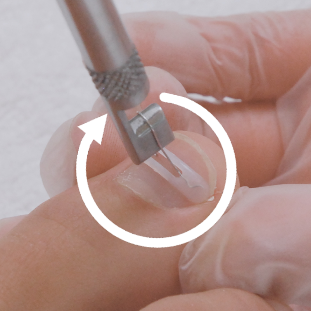 Languettes d’orthonyxie pour ongles incarnés et déformés - Différentes tailles - Podofix - My Médical
