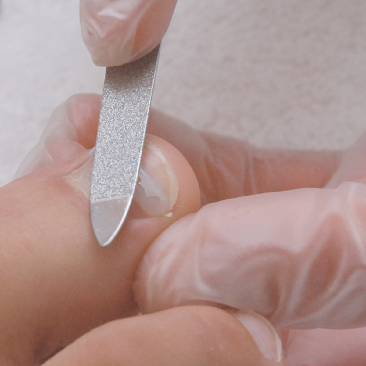 Languettes d’orthonyxie pour ongles incarnés et déformés - Différentes tailles - Podofix - My Médical
