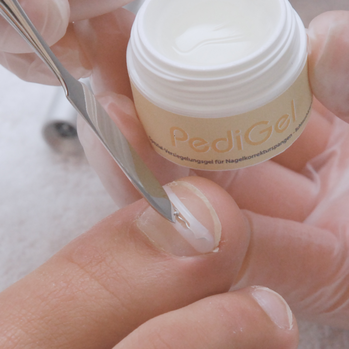 Kit complet d’orthonyxie pour ongles incarnés et déformés – Podofix - My Médical