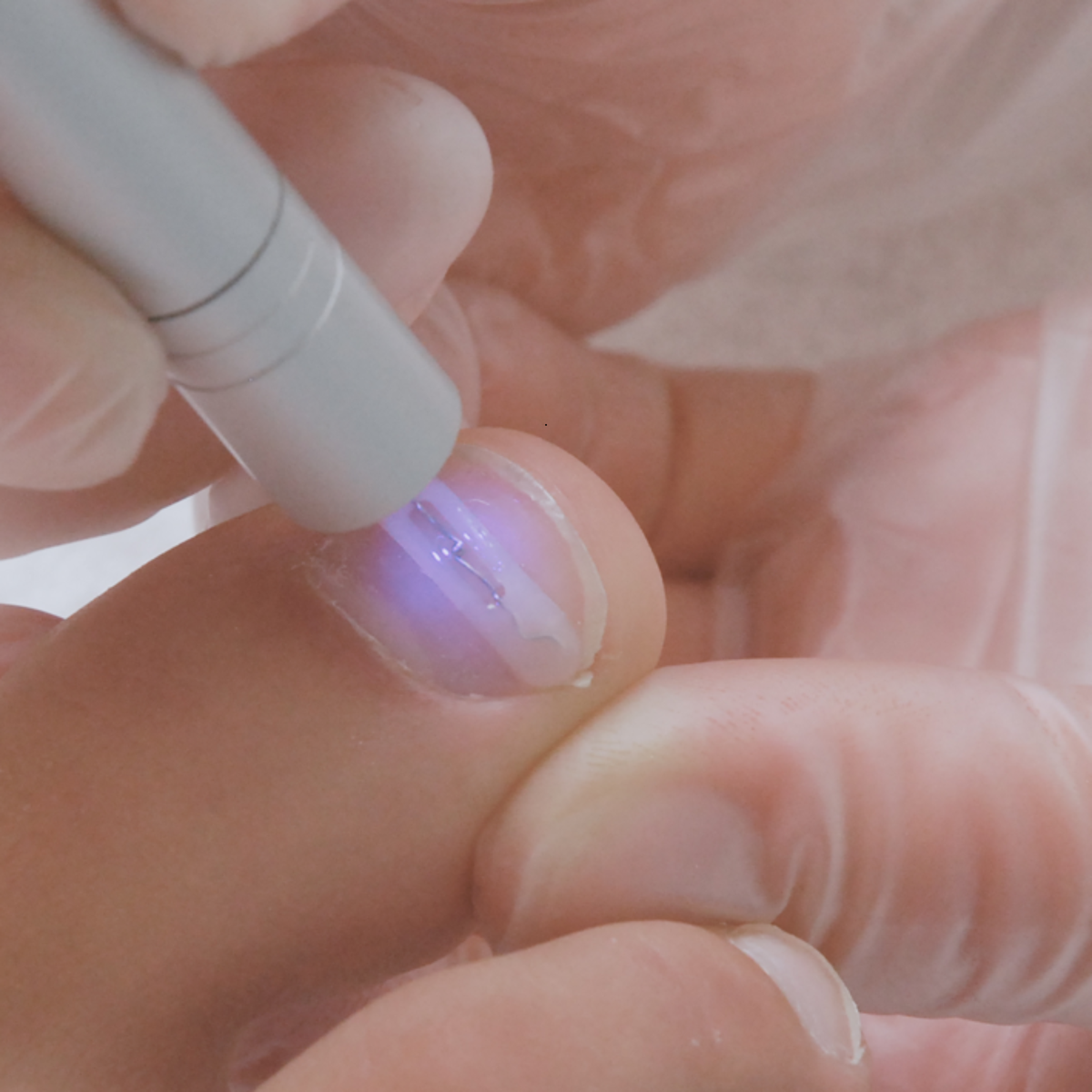 Kit complet d’orthonyxie pour ongles incarnés et déformés – Podofix - My Médical