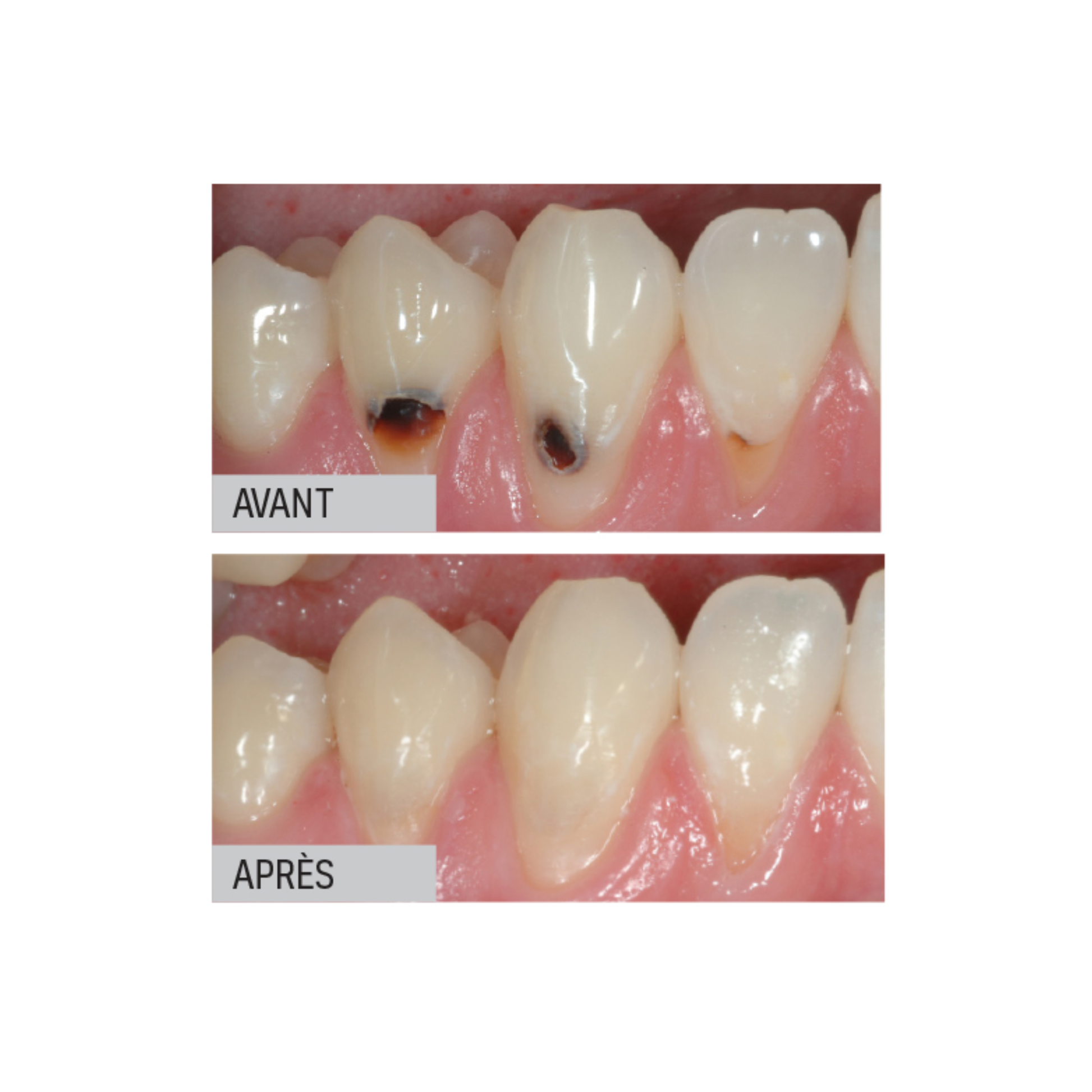 Riva Light Cure - Verre ionomère - 50 capsules - plusieurs teintes - SDI - My Médical