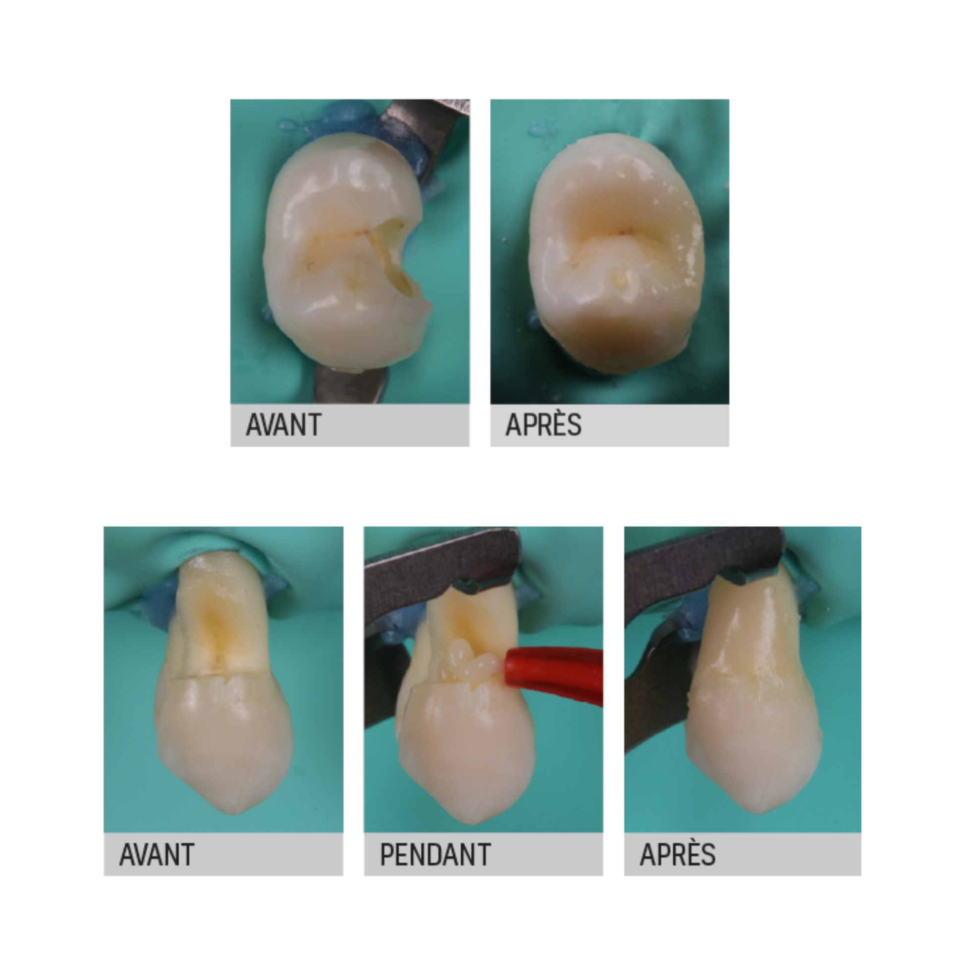 Riva Light Cure - Verre ionomère - 50 capsules - plusieurs teintes - SDI - My Médical